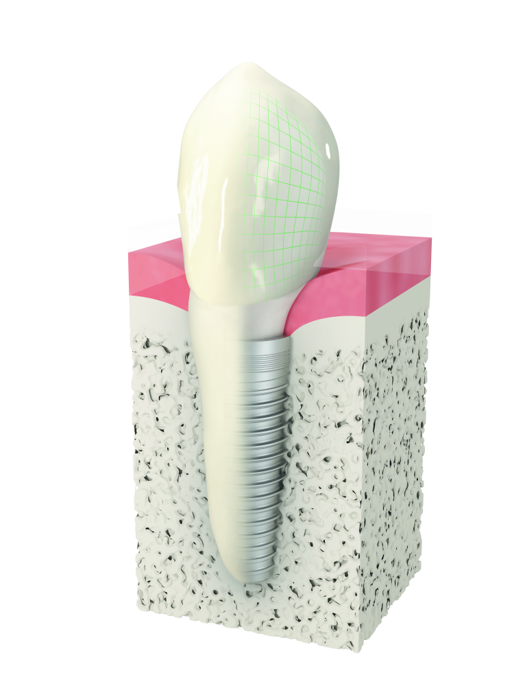 dental implant illustration